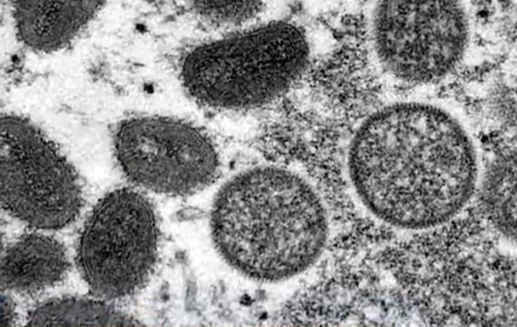 巴西报告88例猴痘确诊病例 圣保罗州占七成